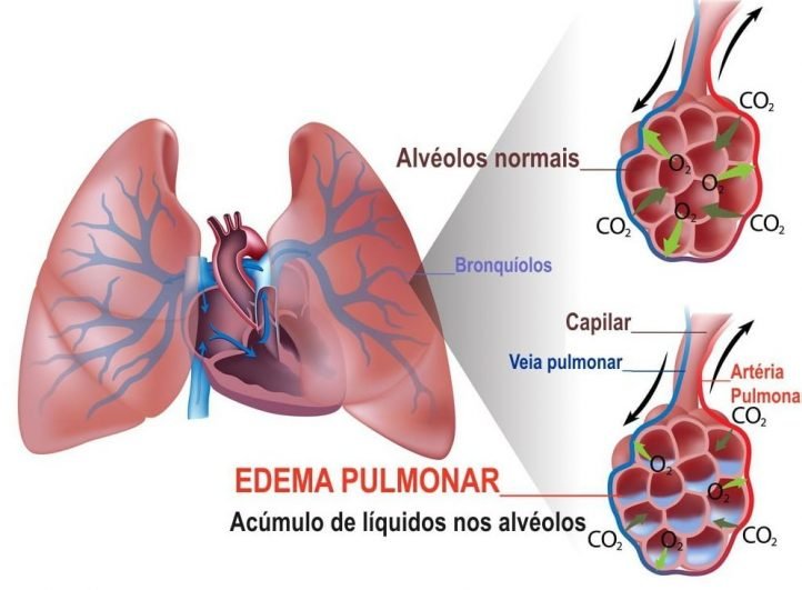 Edema Pulmonar Causas Sintomas E Tratamento Aliance Health Hot Sex