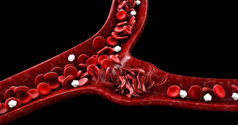 anemia falciforme causas sintomas e tratamento