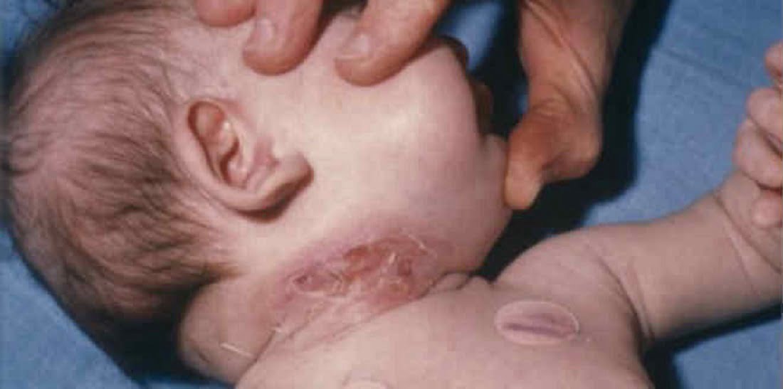 criança com difteria