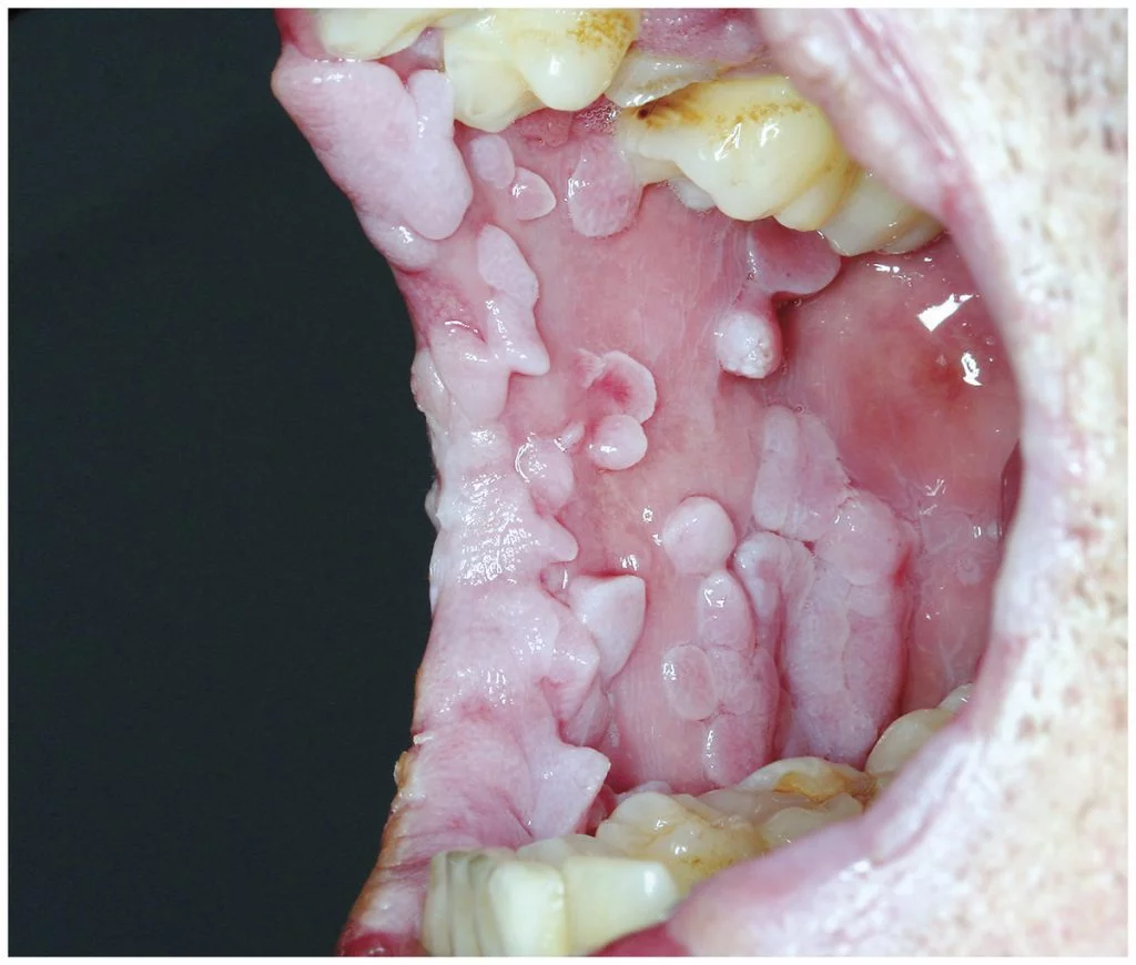 calosidades de papilomavírus humano (HPV) na boca