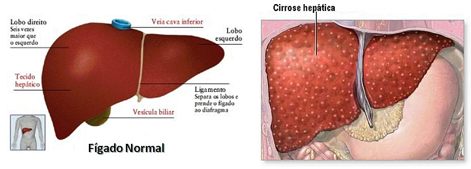 fígado normal e com cirrose