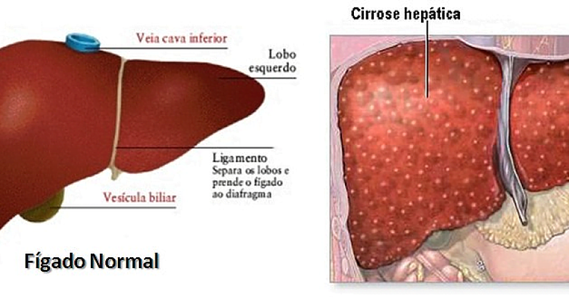 fígado normal e com cirrose