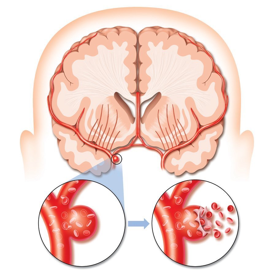 acidente vascular cerebral
