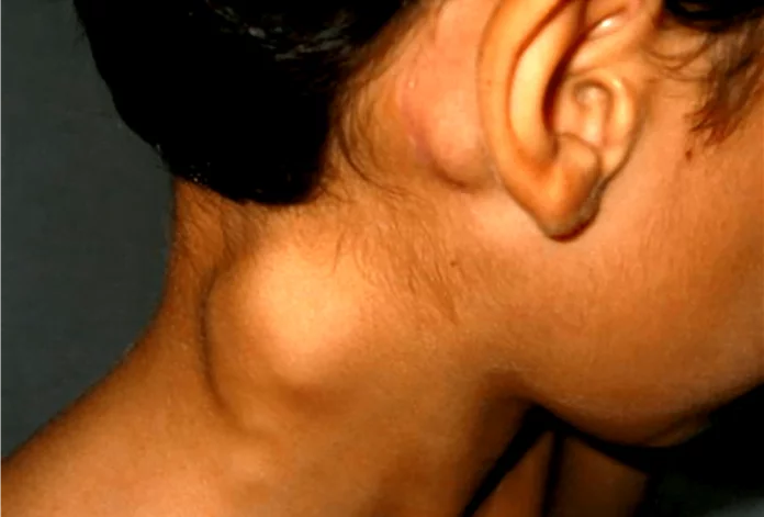 linfoma