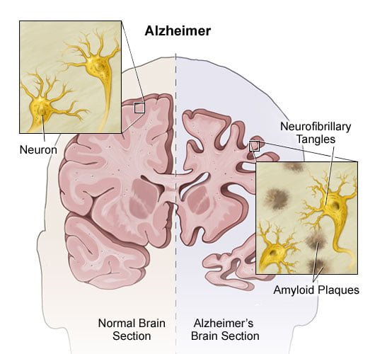 Esquema da doença de alzheimer