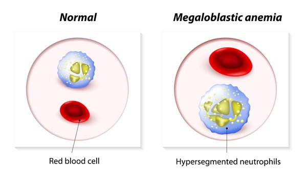 hemácias e a anemia megaloblástica