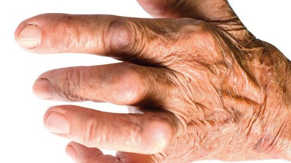 saiba tudo sobre artrite reumatóide