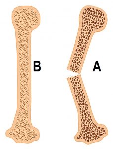 comparação de osso normal (B) e osso com osteoporose (A)