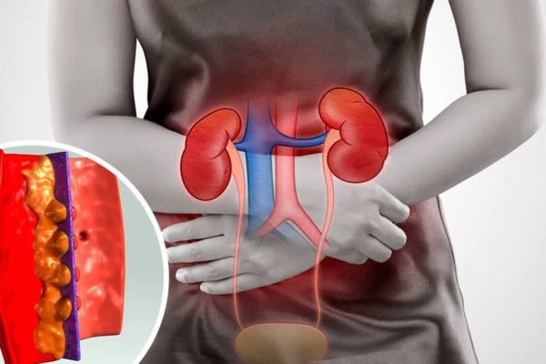 glomerulonefrite