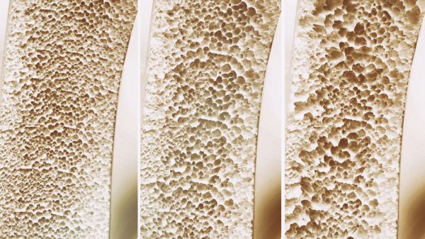 Osteoporose sintomas causas e tratamento