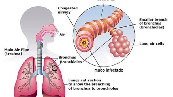 caracterização da bronquite