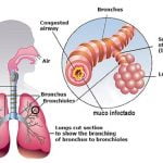 caracterização da bronquite