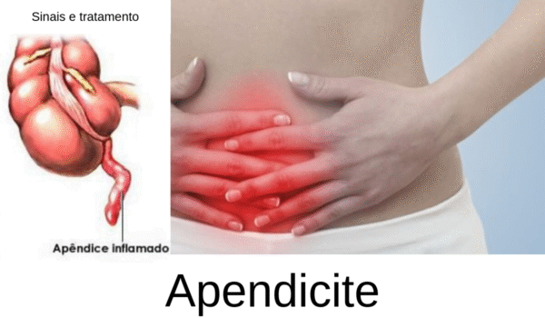 Apendicite: sintomas, causas e tratamento