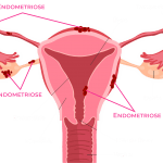 localização esquemática da endometriose