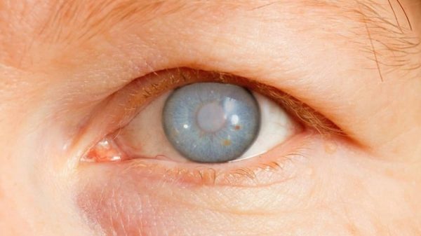 glaucoma, conheça as causas, os sintomas e o tratamento