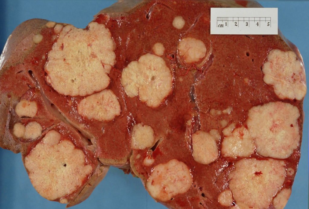 tumor no fígado