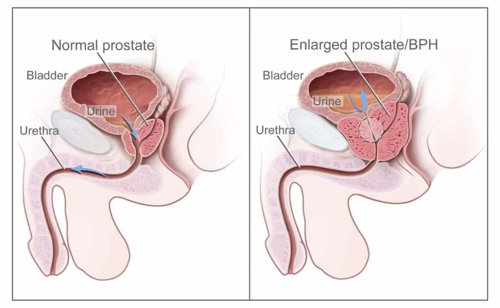 hiperplasia prostática benigna