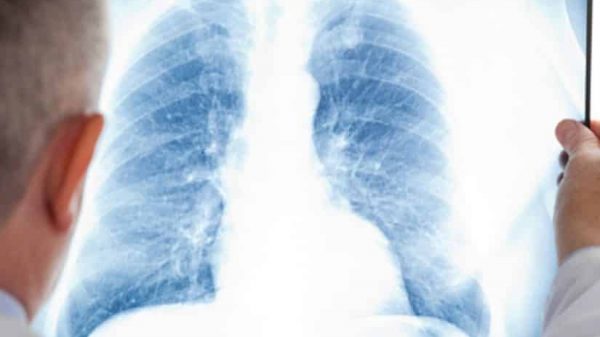 fibrose pulmonar idiopática