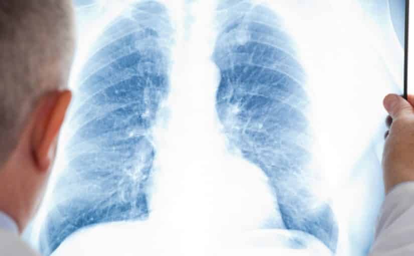 fibrose pulmonar idiopática