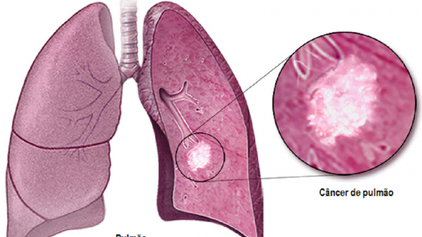 câncer do pulmão