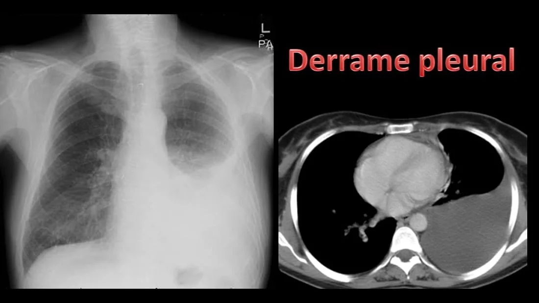derrame pleural