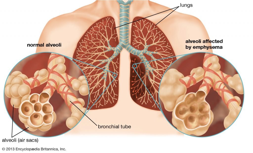 doença pulmonar ostrutiva crônica