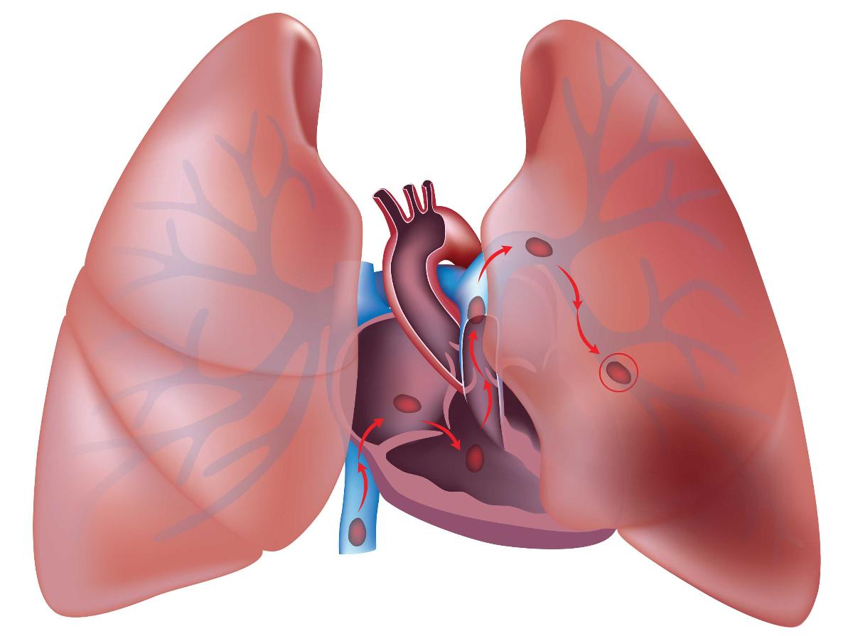 embolia pulmonar