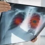 radiografia de uma hipertensãoo pulmonar