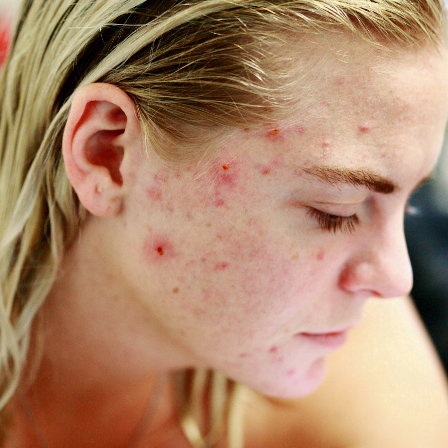 causas e tratamento da acne