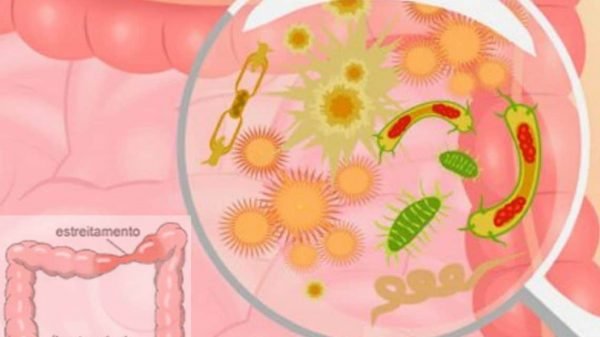 doença inflamatória intestinal