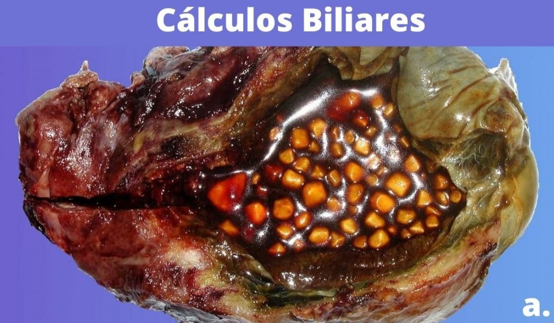 cálculos biliares ou colelitíase