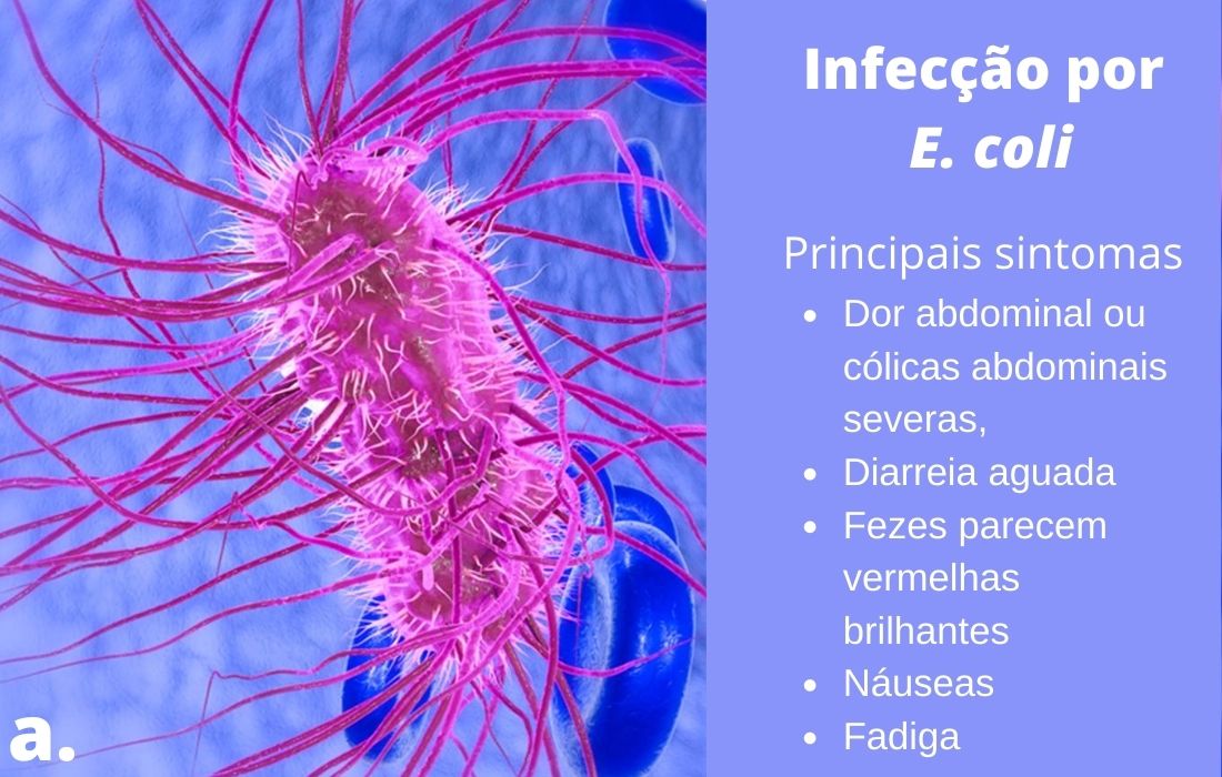 Sinais e sintomas da infeçao por E. coli.