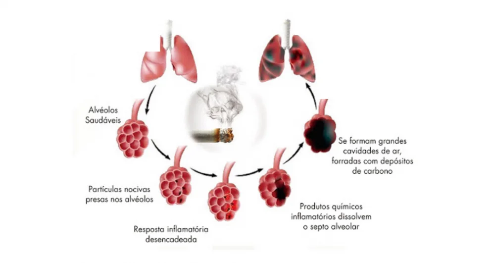 doença pulmonar obstrutiva crônica