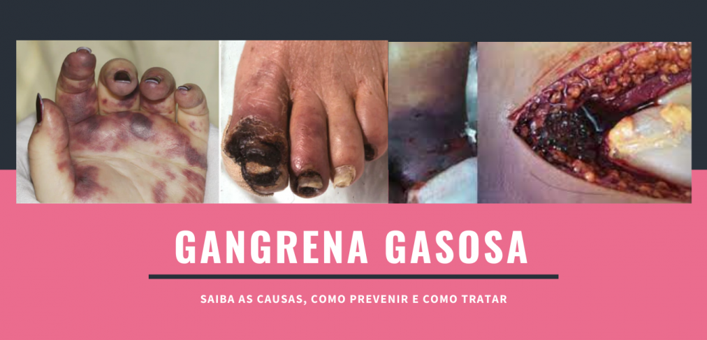 fotos de gangrena gasosa