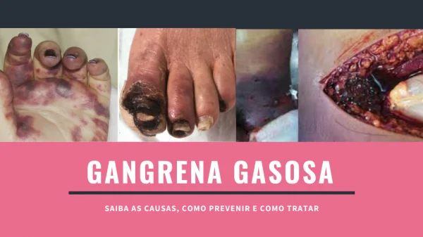 fotos de gangrena gasosa