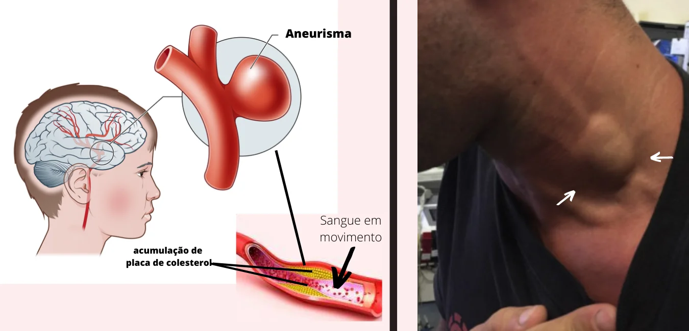 representação do aneurisma e esquema da sua formação