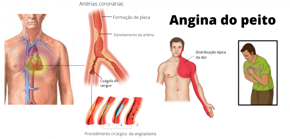 sintomas e tratamento da angina