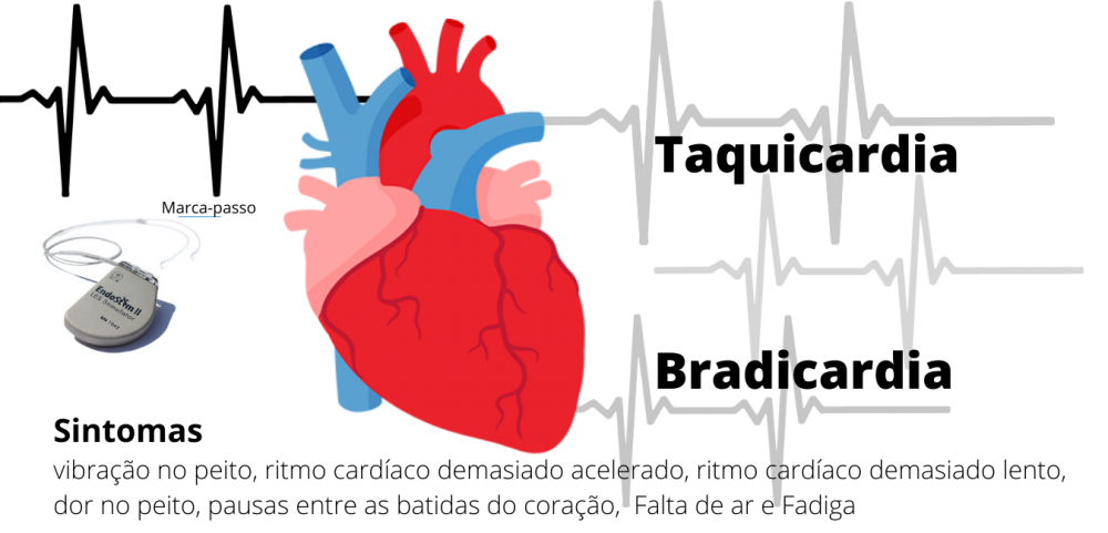 arritmias cardíacas