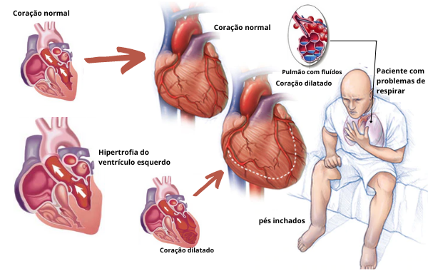 fisiopatologia da insuficiência cardíaca congestiva e seus sintomas