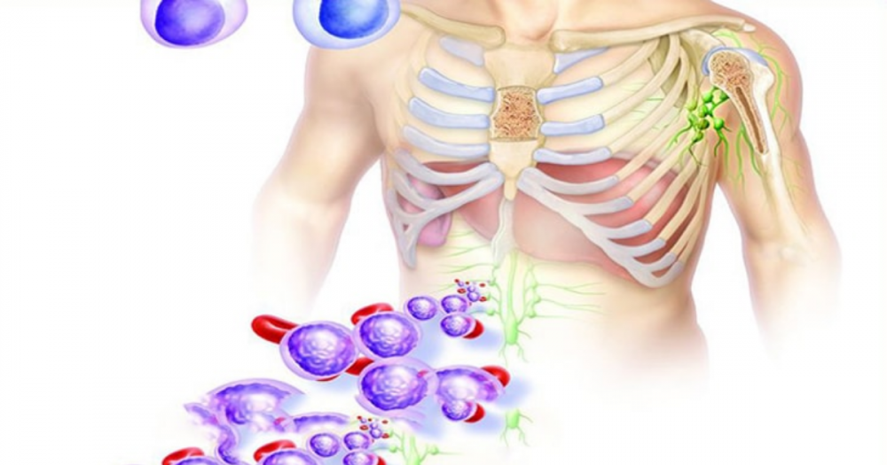 tratamento para leucemia