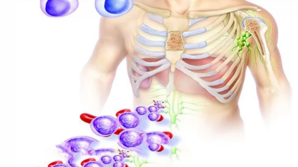 tratamento para leucemia