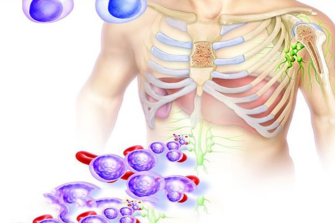 tratamento para leucemia