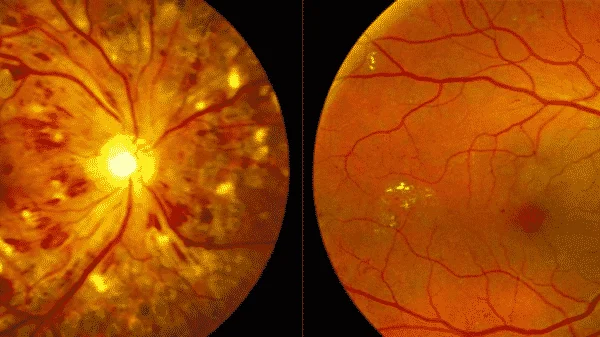retinopatia diabética