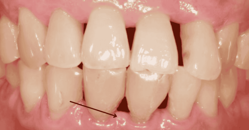 reabsorção óssea alveolar