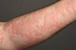 urticaria