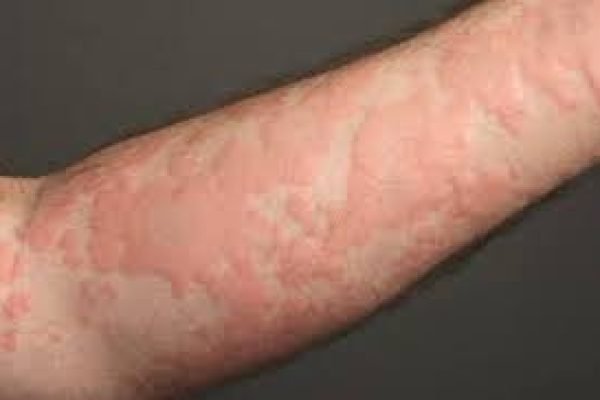 urticaria