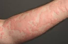 urticaria causada por alergia emocional