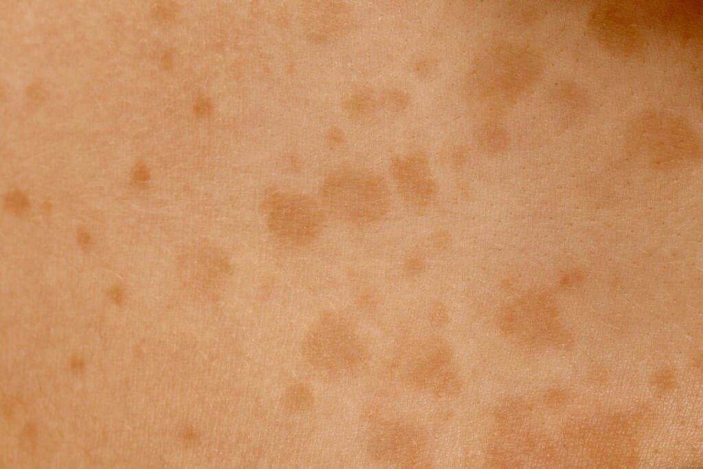 Pitiríase Versicolor: Sinais e Sintomas, Causas e Tratamento