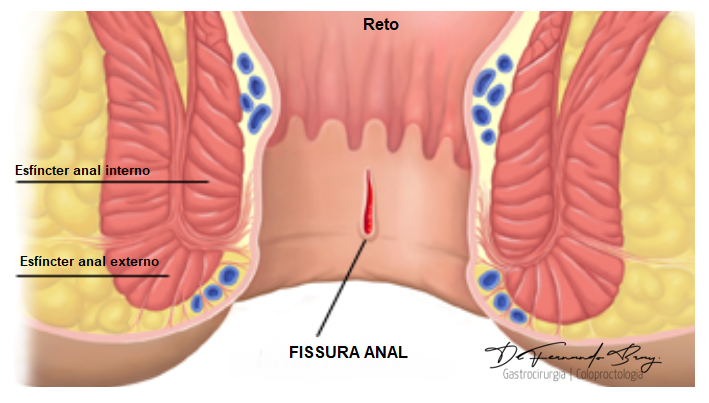 fissura anal