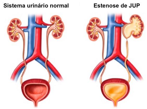 estenose de jup